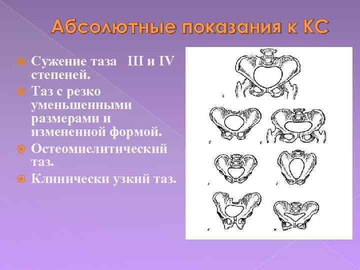 Абсолютные показания к КС Сужение таза III и IV степеней. Таз с резко уменьшенными