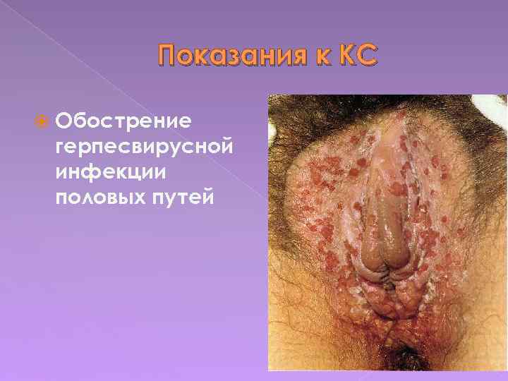Показания к КС Обострение герпесвирусной инфекции половых путей 