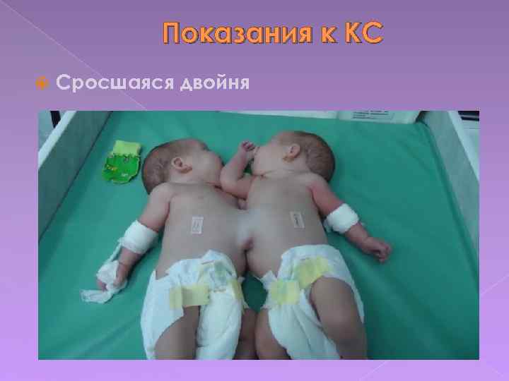 Показания к КС Сросшаяся двойня 