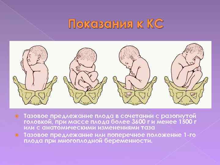 Показания к КС Тазовое предлежание плода в сочетании с разогнутой головкой, при массе плода