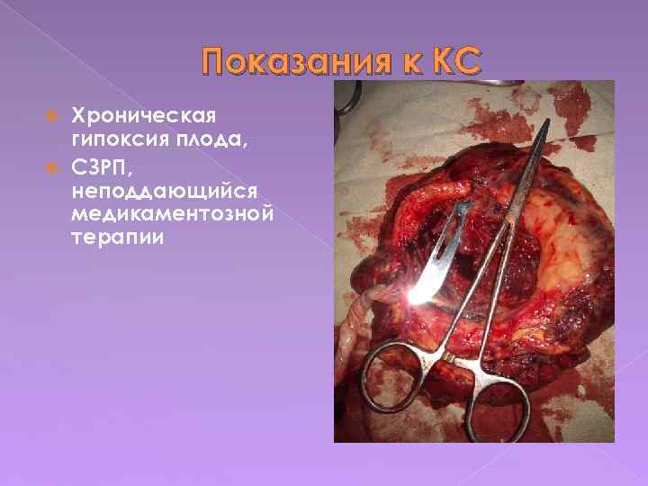 Показания к КС Хроническая гипоксия плода, СЗРП, неподдающийся медикаментозной терапии 