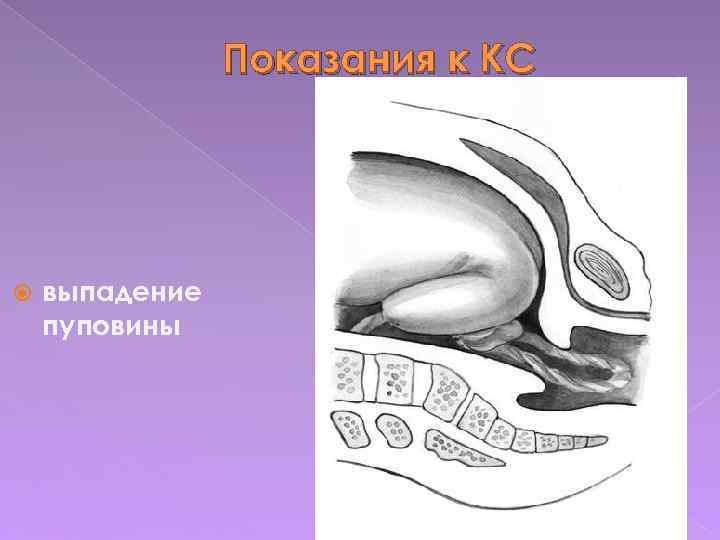 Показания к КС выпадение пуповины 