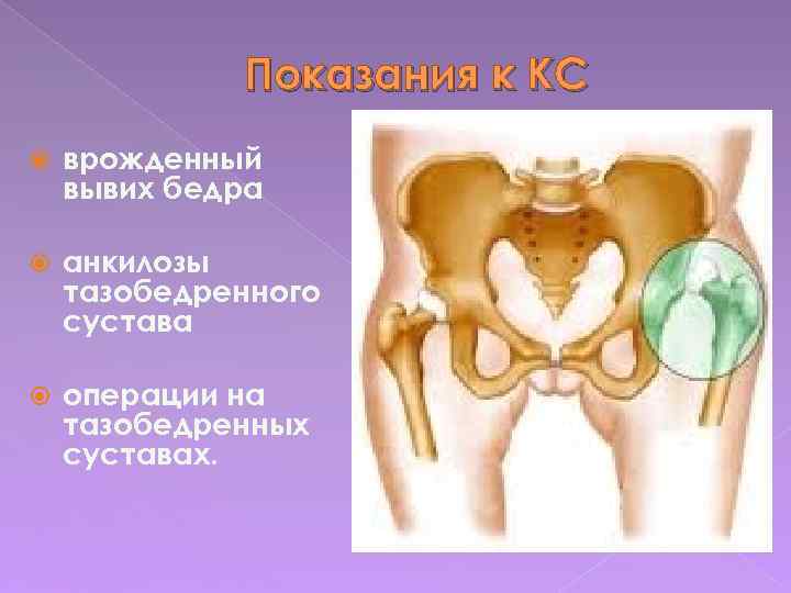 Показания к КС врожденный вывих бедра анкилозы тазобедренного сустава операции на тазобедренных суставах. 