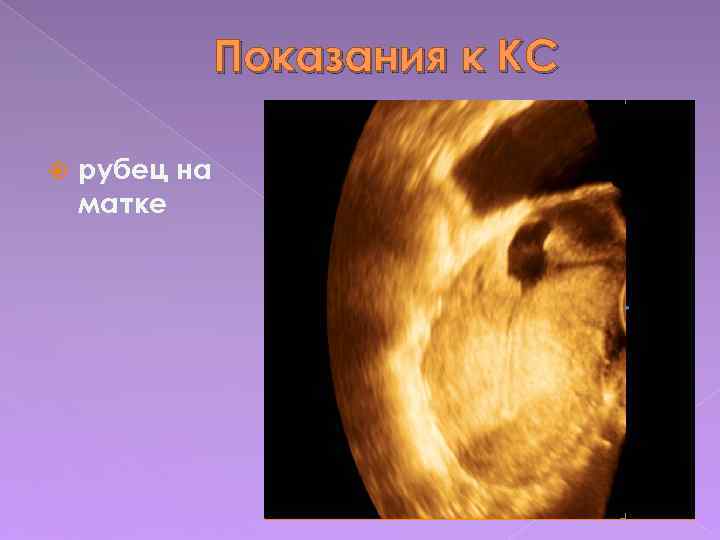 Показания к КС рубец на матке 