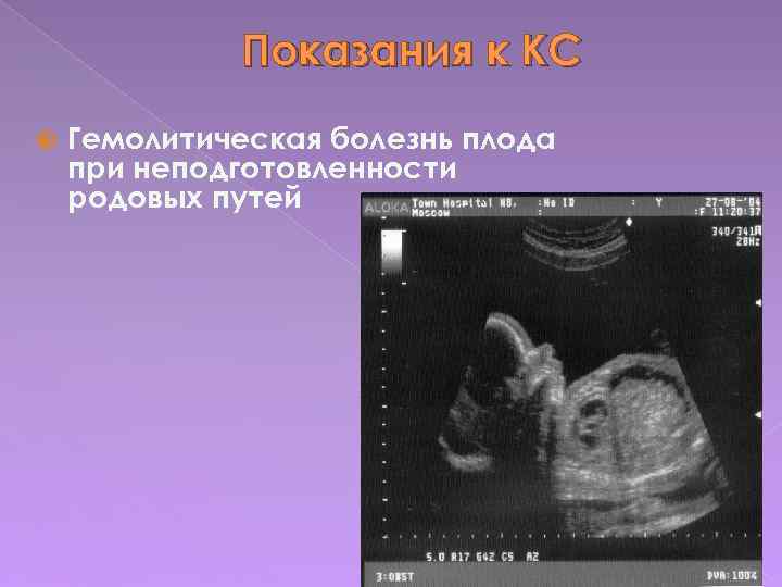 Показания к КС Гемолитическая болезнь плода при неподготовленности родовых путей 