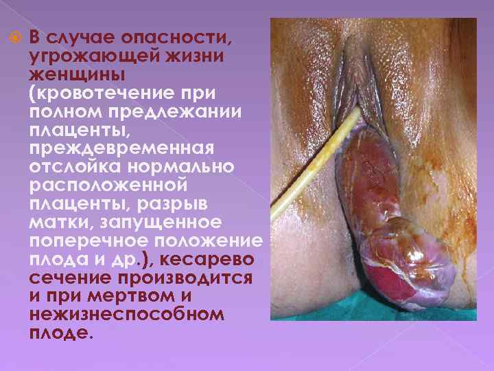  В случае опасности, угрожающей жизни женщины (кровотечение при полном предлежании плаценты, преждевременная отслойка
