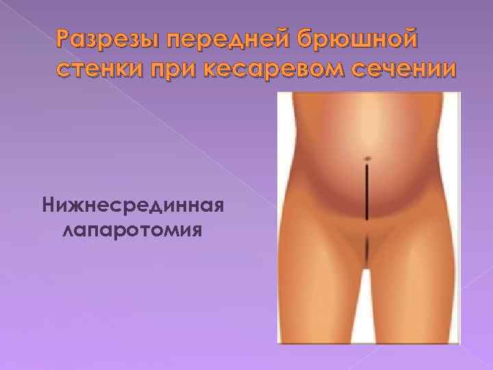 Разрезы передней брюшной стенки при кесаревом сечении Нижнесрединная лапаротомия 