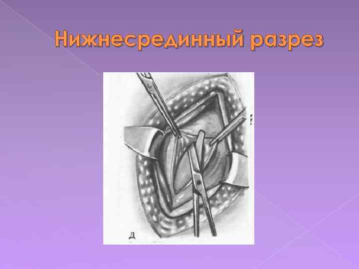 Нижнесрединный разрез 