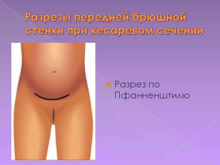 Разрезы передней брюшной стенки при кесаревом сечении Разрез по Пфанненштилю 