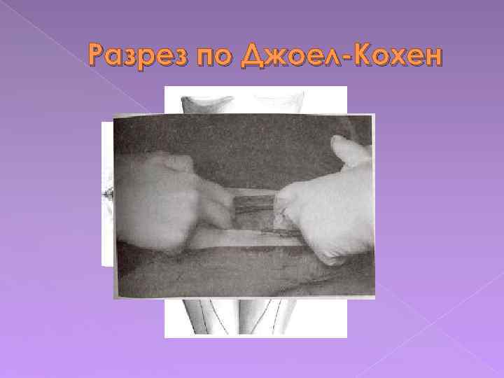 Разрез по Джоел Кохен 