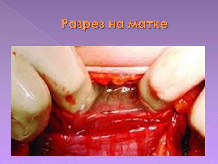 Разрез на матке 