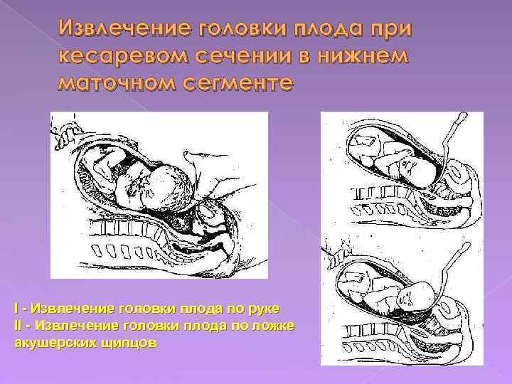 Извлечение головки плода при кесаревом сечении в нижнем маточном сегменте I - Извлечение головки