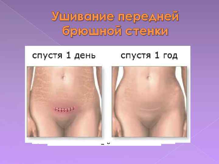 Ушивание передней брюшной стенки 