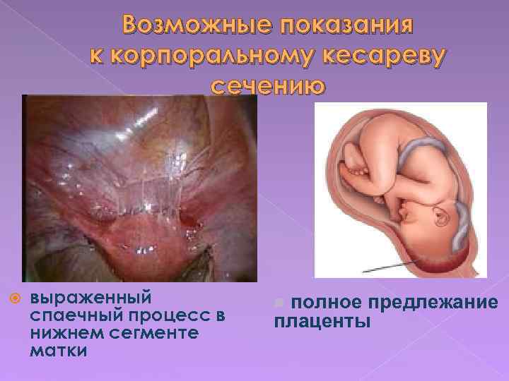Возможные показания к корпоральному кесареву сечению выраженный спаечный процесс в нижнем сегменте матки полное