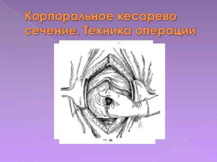 Корпоральное кесарево сечение. Техника операции 