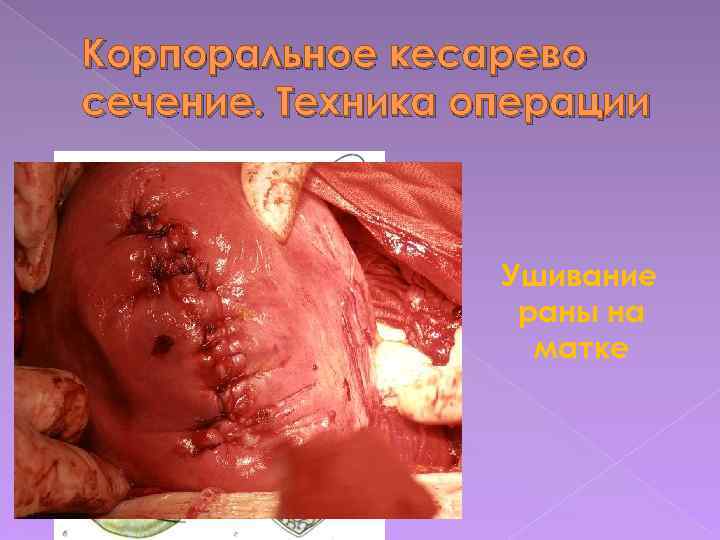 Корпоральное кесарево сечение. Техника операции Ушивание раны на матке 