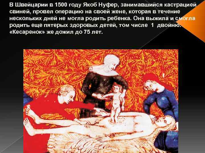 В Швейцарии в 1500 году Якоб Нуфер, занимавшийся кастрацией свиней, провел операцию на своей