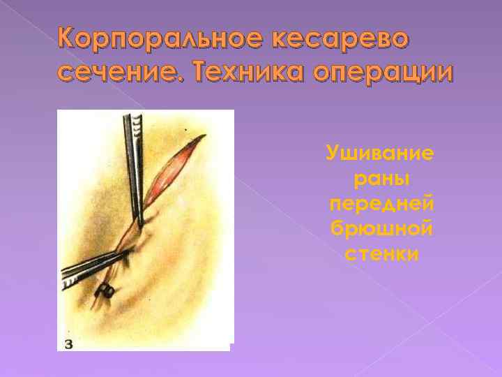 Корпоральное кесарево сечение. Техника операции Ушивание раны передней брюшной стенки 