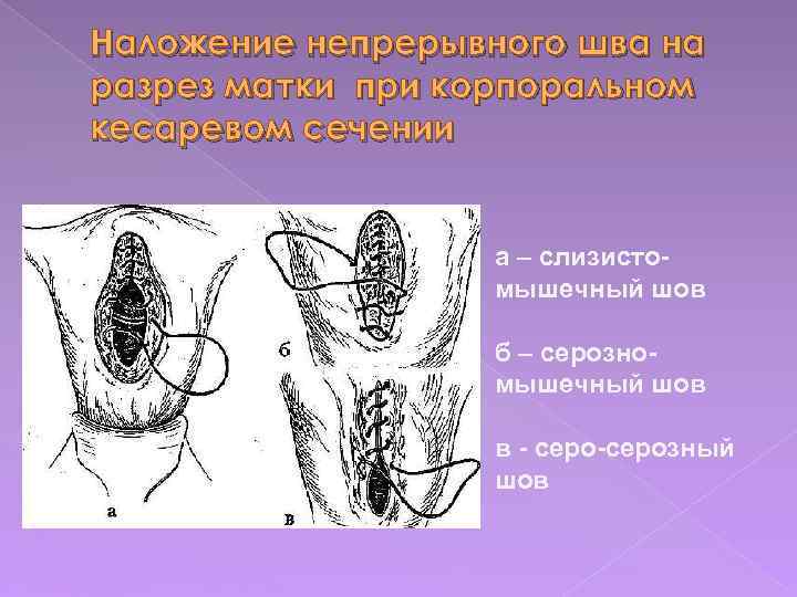 Наложение непрерывного шва на разрез матки при корпоральном кесаревом сечении а – слизистомышечный шов