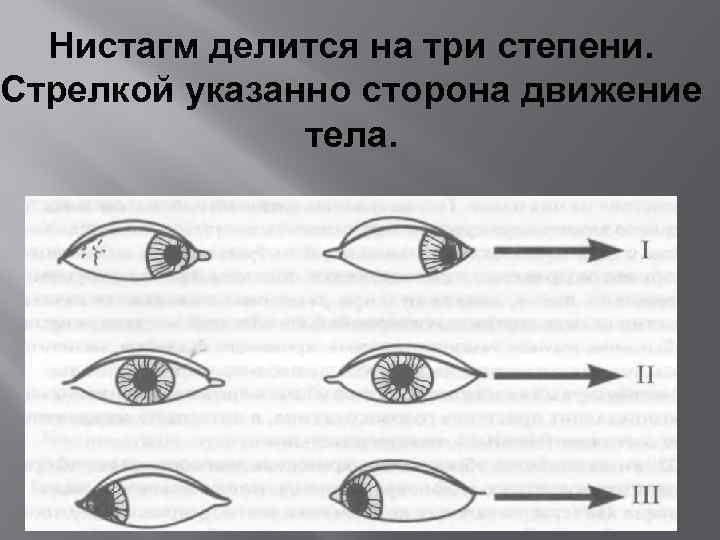 Нистагм делится на три степени. Стрелкой указанно сторона движение тела. 