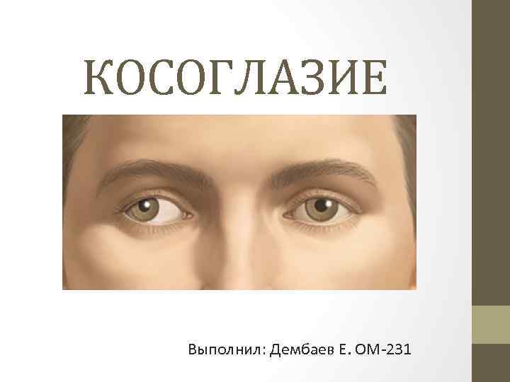 Косоглазие у взрослых. Косоглазие рисунок. Скрытое косоглазие. Косоглазие физика. Косоглазие презентация.