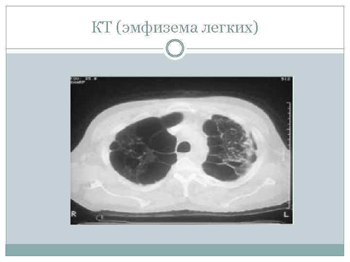 КТ (эмфизема легких) 