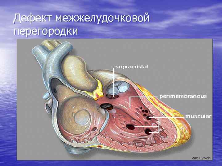 Дефект межжелудочковой перегородки 