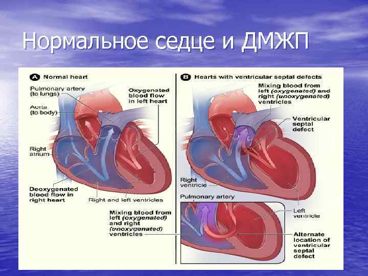 Нормальное седце и ДМЖП 