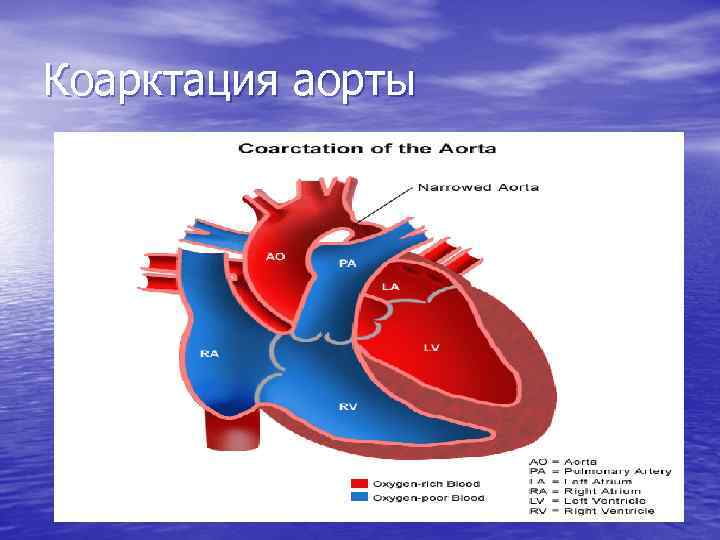 Коарктация аорты 