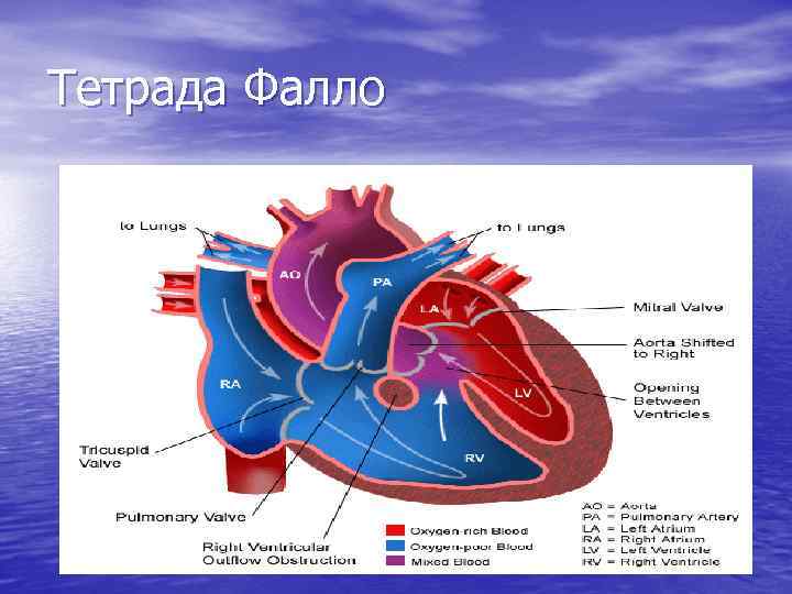 Тетрада Фалло 