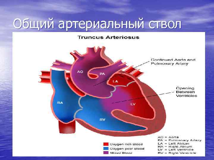 Общий артериальный ствол 