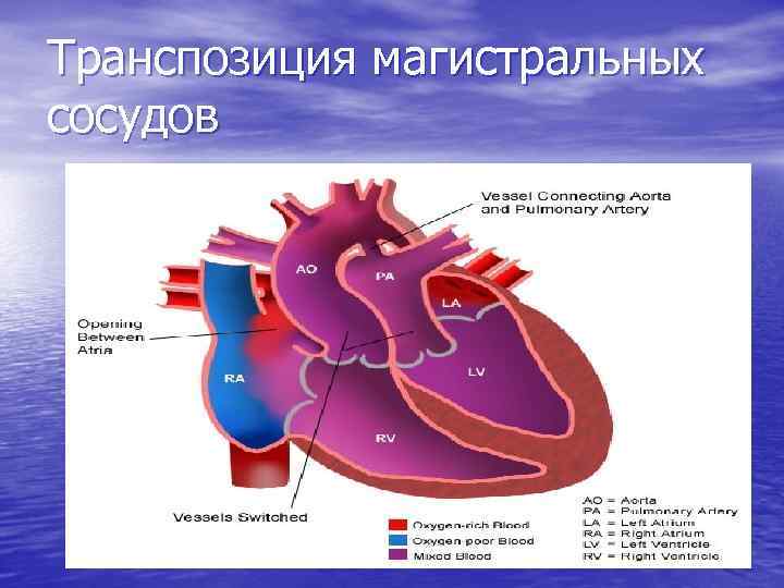 Транспозиция магистральных сосудов 