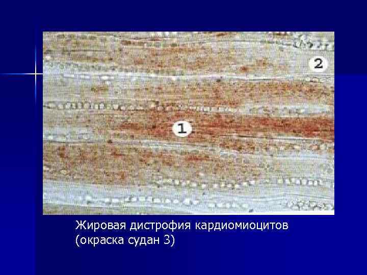 Жировая дистрофия кардиомиоцитов (окраска судан 3) 