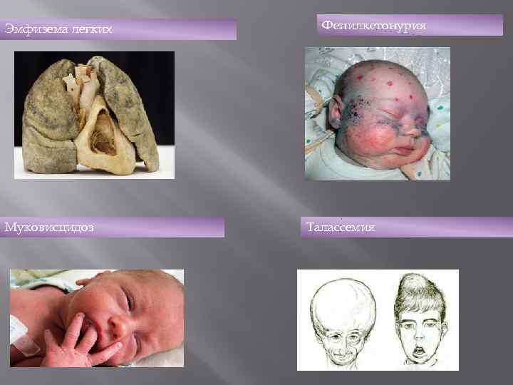 Эмфизема легких Муковисцидоз Фенилкетонурия Талассемия 