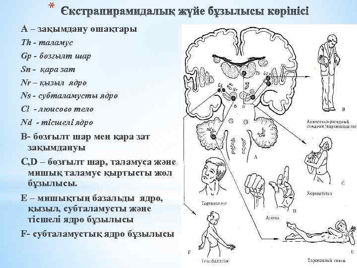 * А – зақымдану ошақтары Тh - таламус Gp - бозғылт шар Sn -