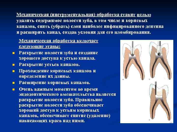 Механическая (инструментальная) обработка ставит целью удалить содержимое полости зуба, в том числе и корневых