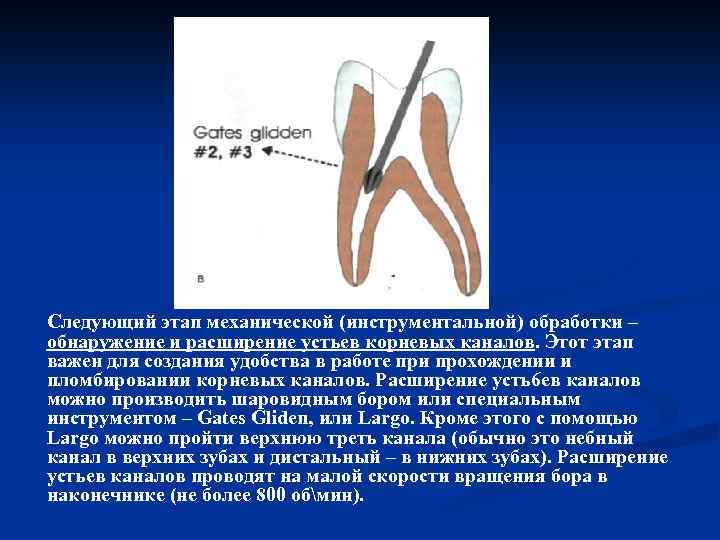 Следующий этап механической (инструментальной) обработки – обнаружение и расширение устьев корневых каналов. Этот этап