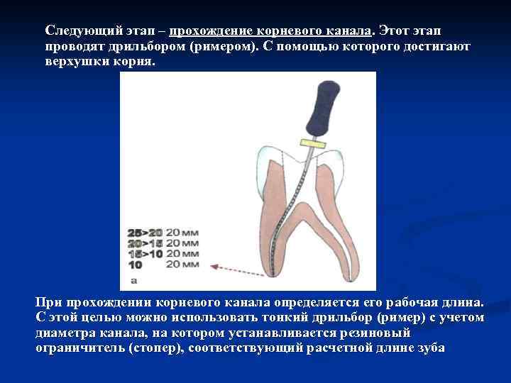 Следующий этап – прохождение корневого канала. Этот этап проводят дрильбором (римером). С помощью которого