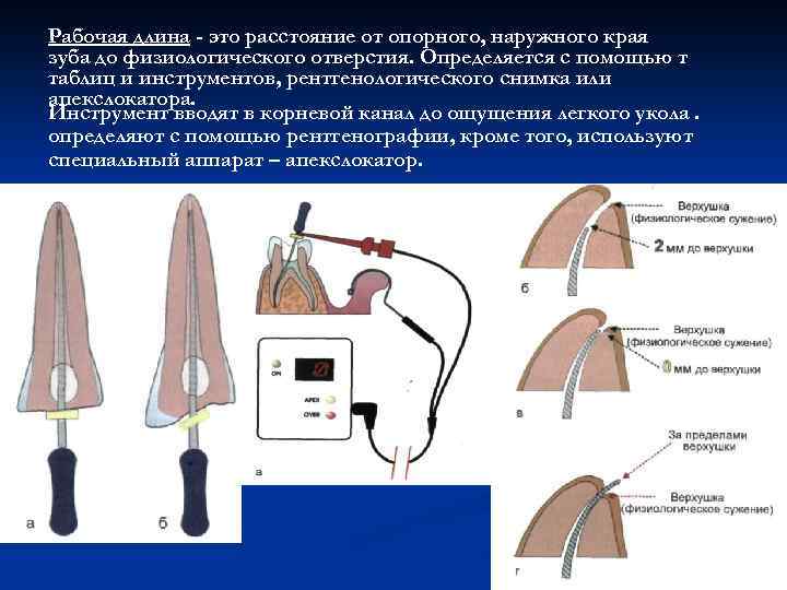 Рабочая длина - это расстояние от опорного, наружного края зуба до физиологического отверстия. Определяется