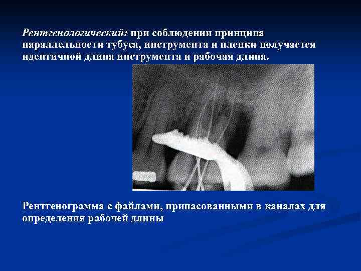 Рентгенологический: при соблюдении принципа параллельности тубуса, инструмента и пленки получается идентичной длина инструмента и