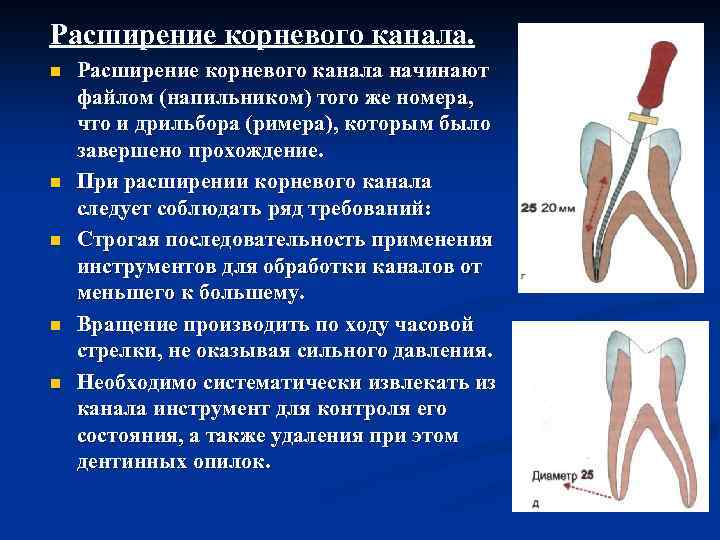 Расширение корневого канала. n n n Расширение корневого канала начинают файлом (напильником) того же