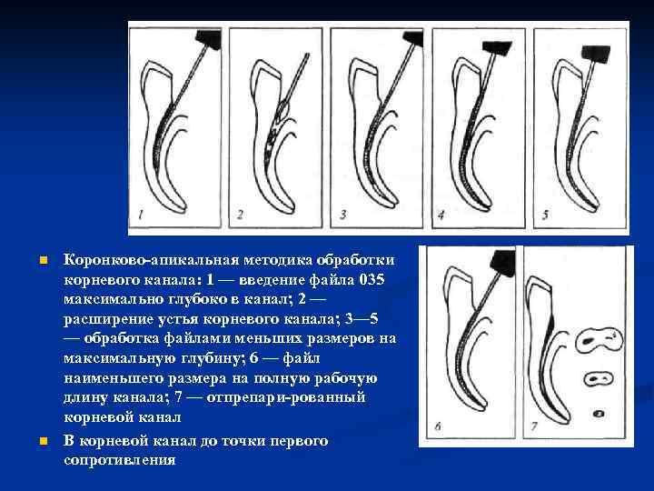 n n Коронково апикальная методика обработки корневого канала: 1 — введение файла 035 максимально