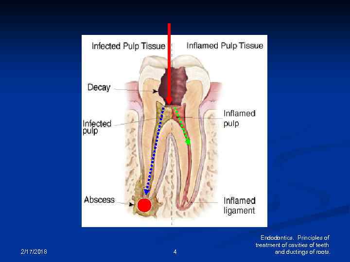 2/17/2018 4 Endodontics. Principles of treatment of cavities of teeth and ductings of roots.