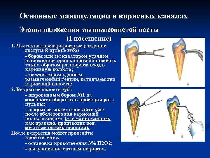 Основные манипуляции в корневых каналах Этапы наложения мышьяковистой пасты (I посещение) 1. Частичное препарирование