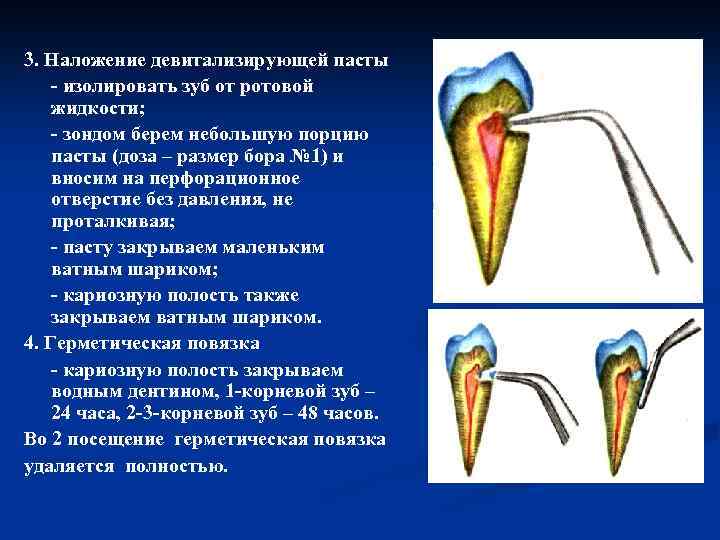 3. Наложение девитализирующей пасты изолировать зуб от ротовой жидкости; зондом берем небольшую порцию пасты