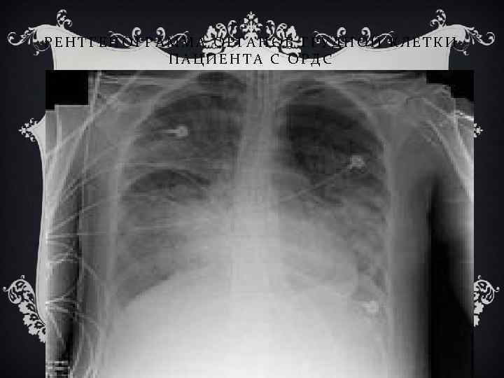 РЕНТГЕНОГРАММА ОРГАНОВ ГРУДНОЙ КЛЕТКИ ПАЦИЕНТА С ОРДС 
