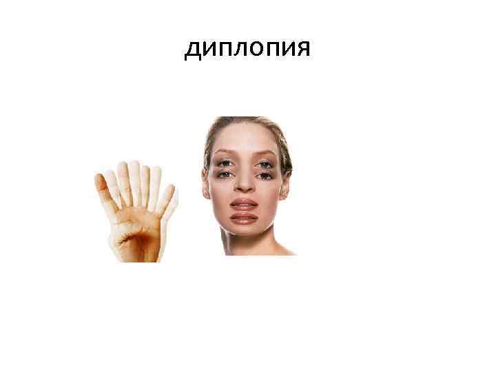 диплопия 