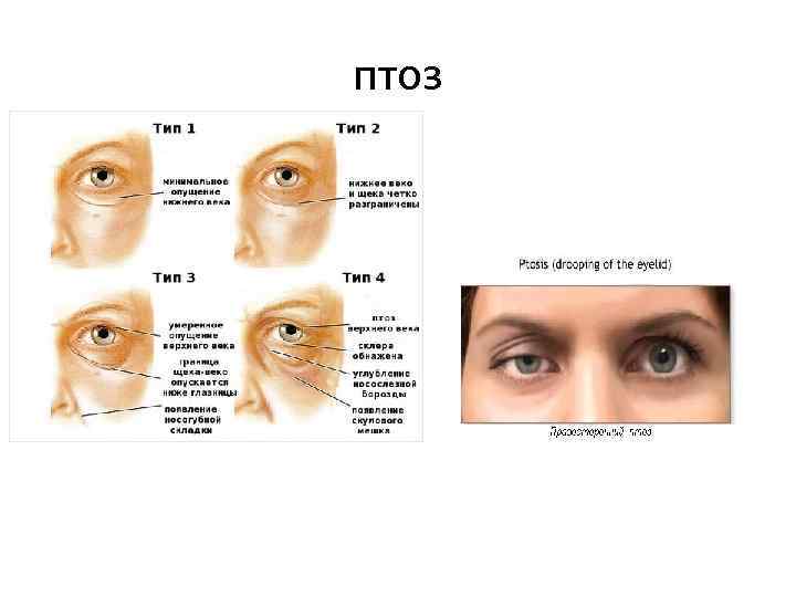 птоз 