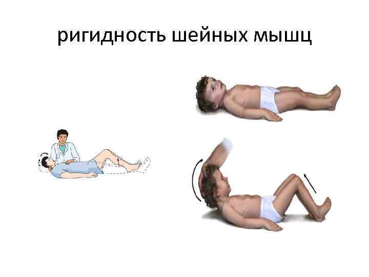 ригидность шейных мышц 