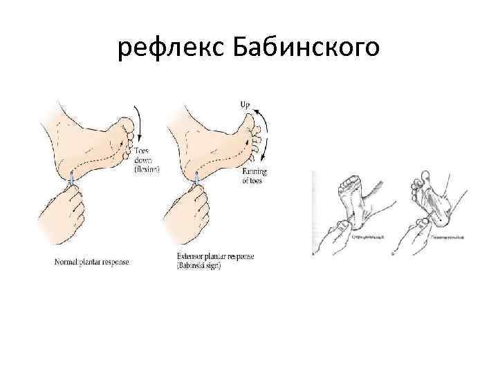 рефлекс Бабинского 
